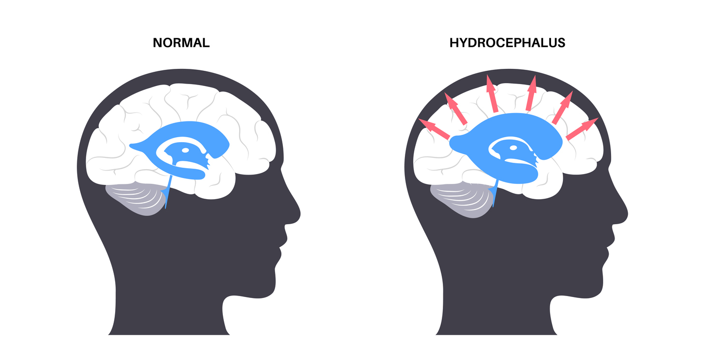 Graphic representation of a normal brain and a brain with hydrocephalus