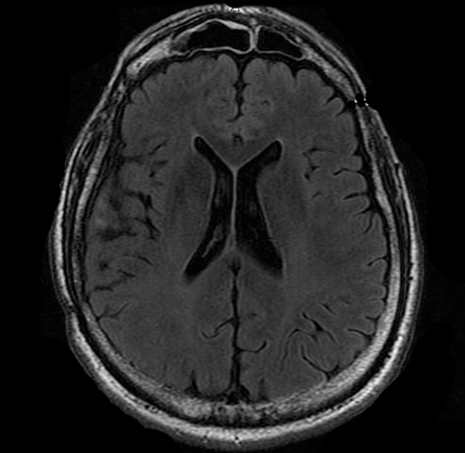 normal brain mri