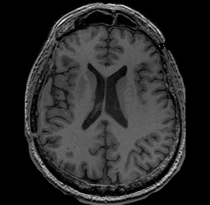 T1-Weighted MRI