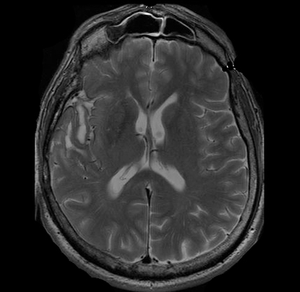 T2-Weighted MRI