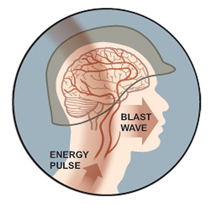The Mechanics of a Blast Injury | BrainLine