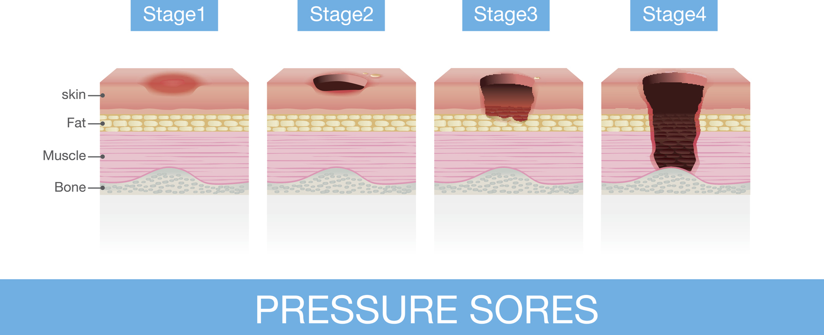 Medical diagram of pressure sores