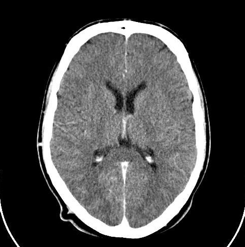 A grayscale screenshot of a CT scan of the brain