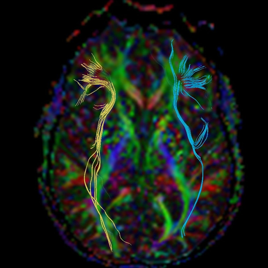 Diffusion Tensor Image of the brain - bright colored lines of movement through the brain
