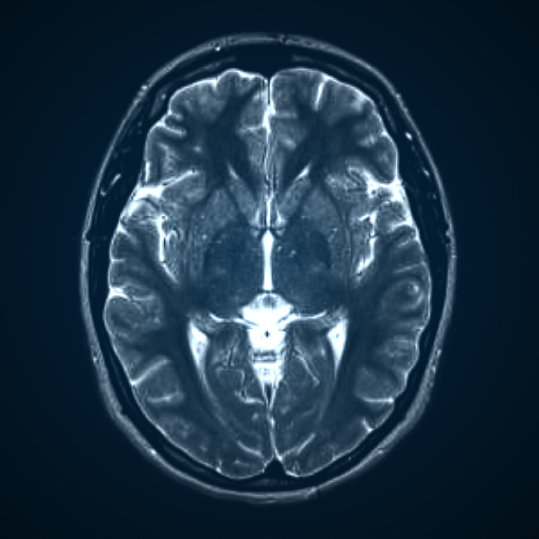 Magnetic Resonance Imaging (MRI) view of a brain
