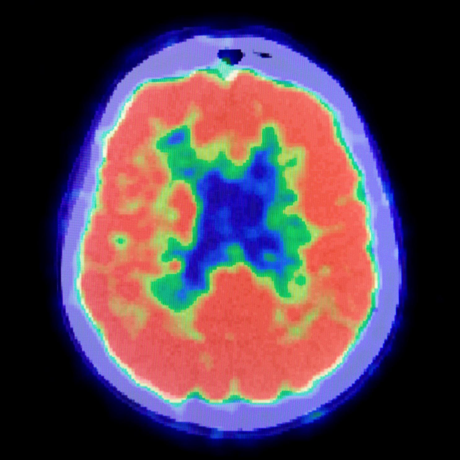Positron Emission Topography (PET) image of a brain in bright red and skull in bright blue with yellows, greens and deep blues in the center