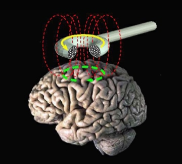Graphic representation of a Transcranial Magnetic Stimulation (TMS) device floating over a brain