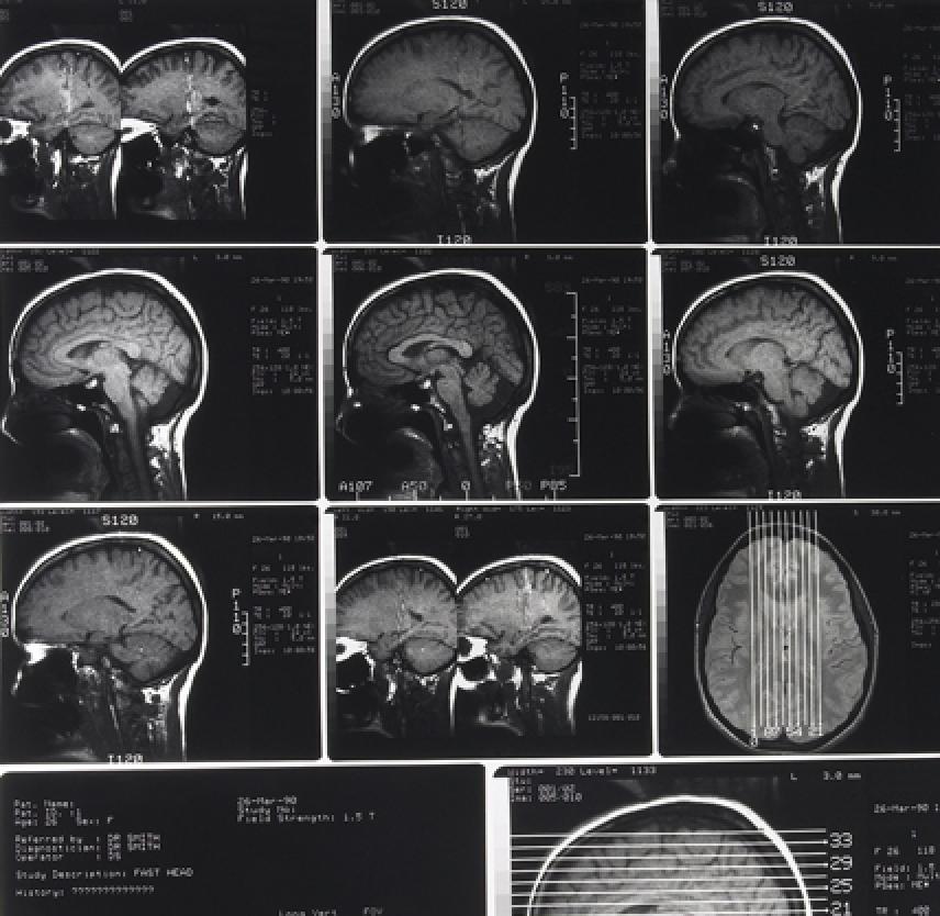 Traumatic Brain Injury Mri