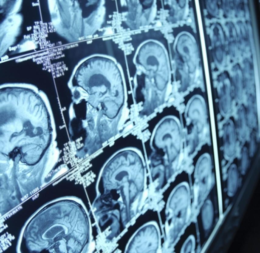 Brain Swelling After Concussion