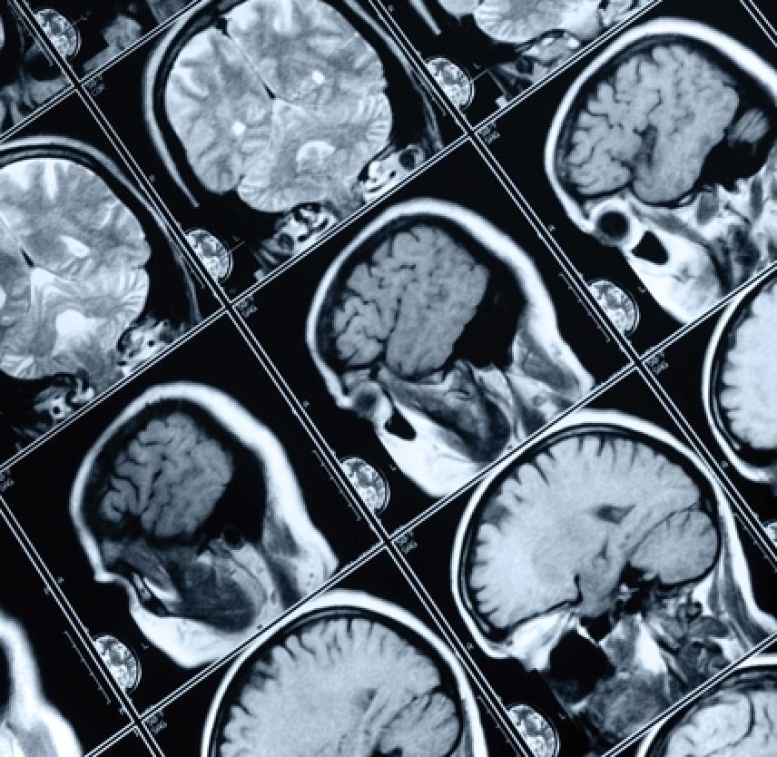 Las Lesiones Cerebrales Traumáticas