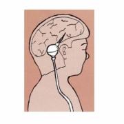Illustration of a brain shunt