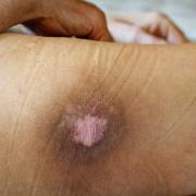 A bed sore on a person's leg