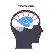 Graphic representation of hydrocephalus