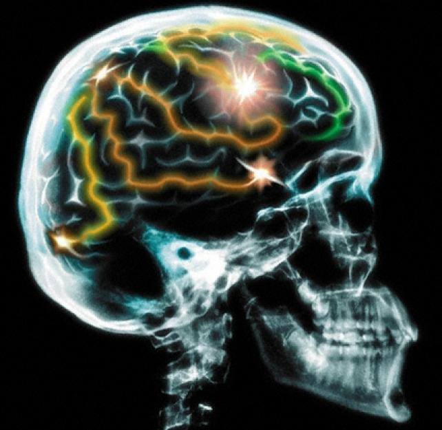 Harnessing the Brain's Power to Adapt After Surgery