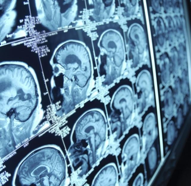 Understanding TBI, Part 1: What Happens to the Brain During Injury and in the Early Stages of Recovery from TBI?