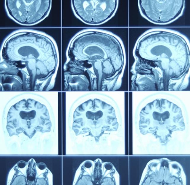 Traumatismo cerebral: Esperanza en la investigaciÃ³n