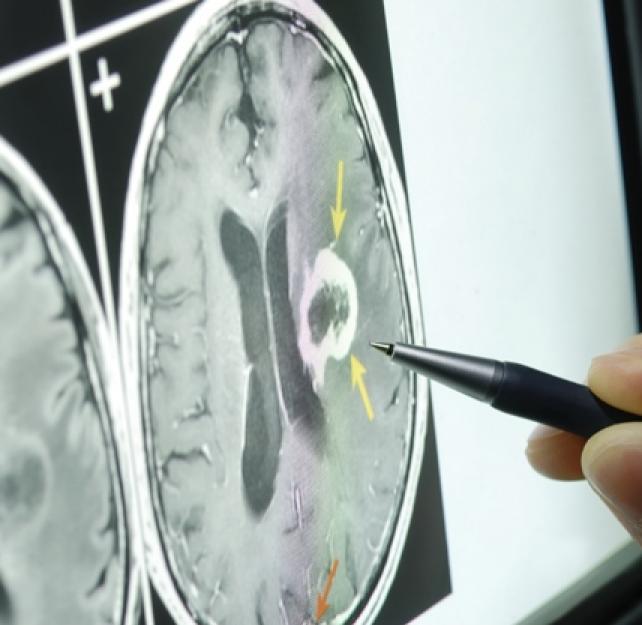 What Imaging Techniques are Used to Diagnose Traumatic Brain Injury?
