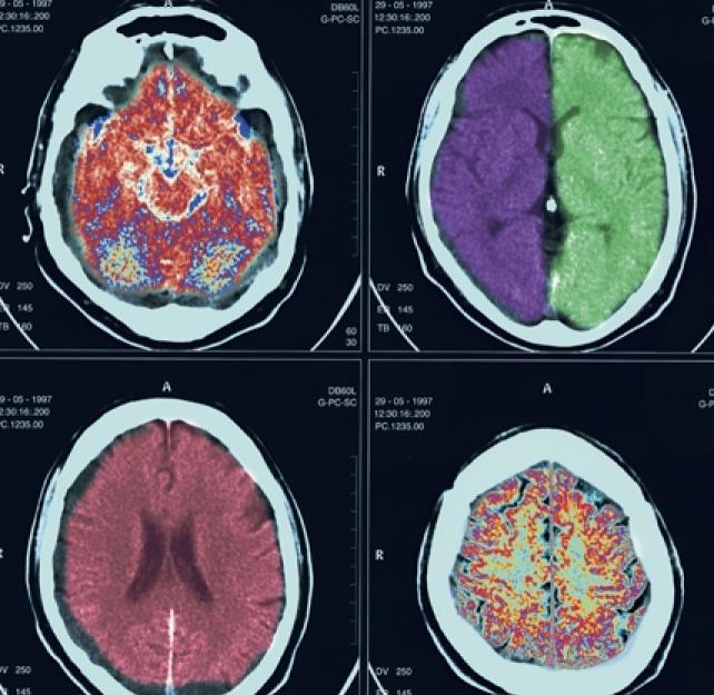 Types of Neuroimaging