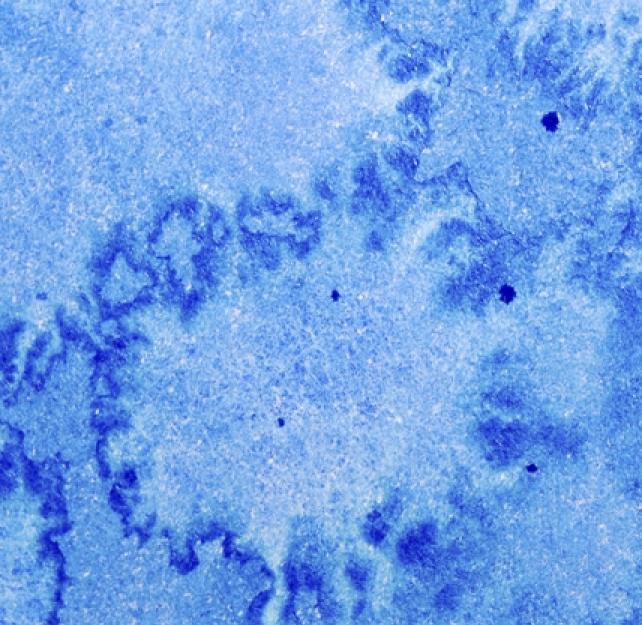 TBI May Be as Complex as Cancer