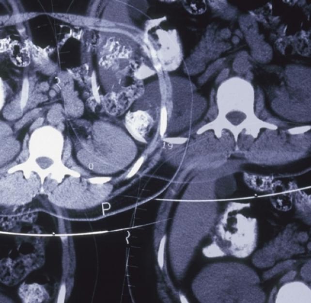 Dr. Stuart Hoffman: Better Imaging for Brain Injury with Diffusion Tensor Imaging