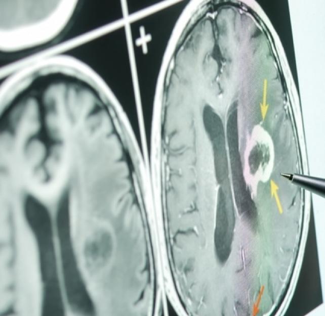 The Pathology of TBI-Related Seizures