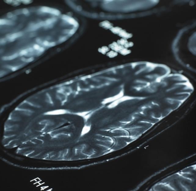 Decoding Chronic Traumatic Encephalopthy