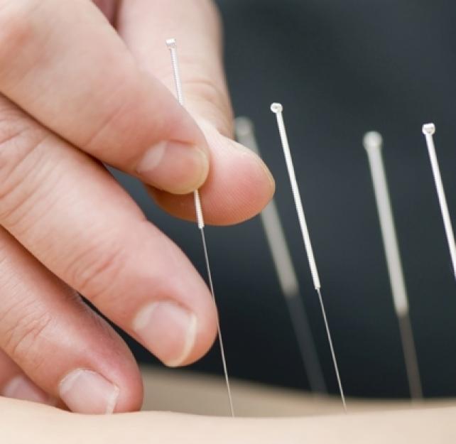 How Does Acupuncture Help People with TBI?