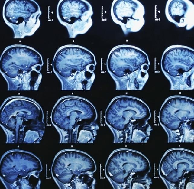 What Is the Ideal Timeline to Do MRIs, fMRIs, DTIs, and Fiber Tracking to Diagnose TBI?