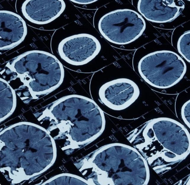 Brain Injuries: Silent Epidemic