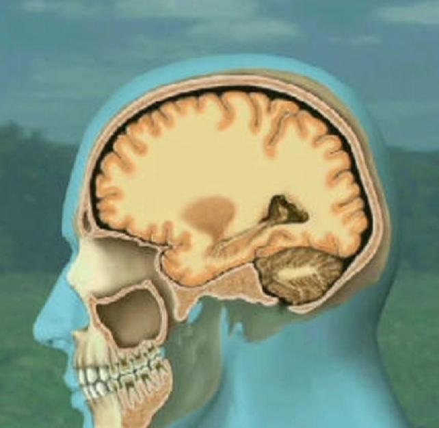 Animated Deceleration Injury from a Traumatic Brain Injury