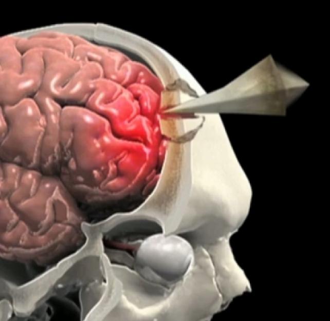 Penetrating Brain Injury Animation