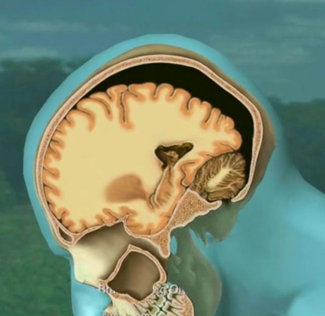 Animated Mild Traumatic Brain Injury