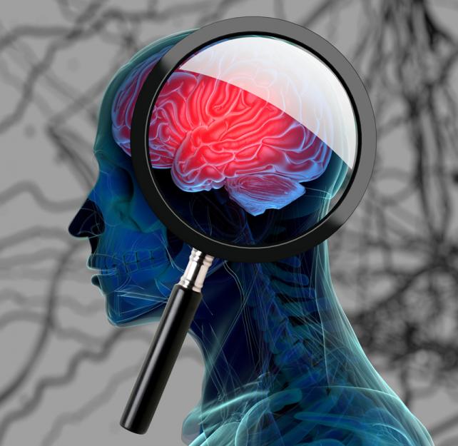 CTE: How repeated head blows affect the brain