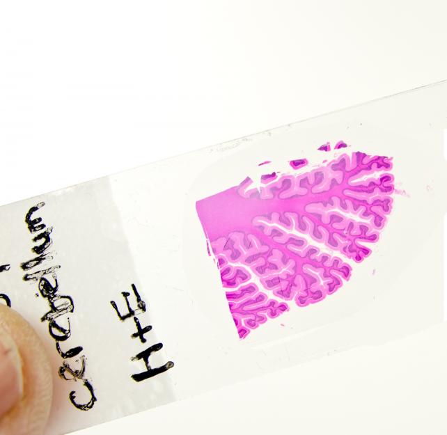 Dr. Ann McKee: The Work of a Neuropathologist