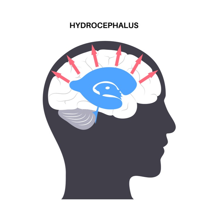 Graphic representation of hydrocephalus